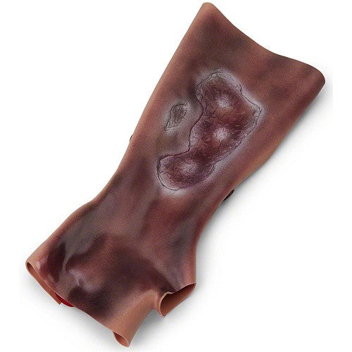 Simulaids Forearm With Simulated 2nd & 3rd Degree Burns