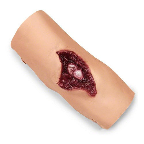 Simulaids Compound Fracture Humerus/Upper Arm